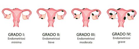 Schema dell'endometrio e delle lesioni endometriosiche