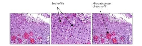Immagini istologiche di lesioni endometriosiche in topi trattati con DCI