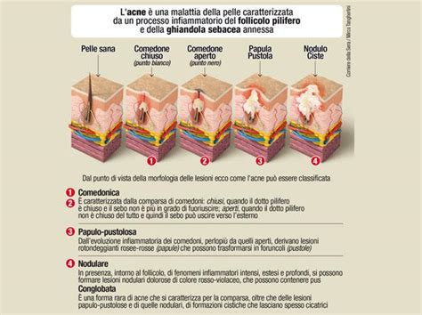 Illustrazione delle diverse tipologie di lesioni acneiche