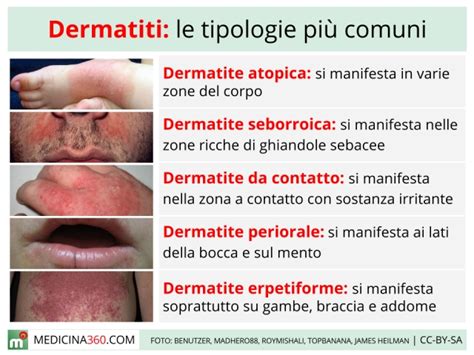 Schema che illustra le diverse tipologie di dermatiti
