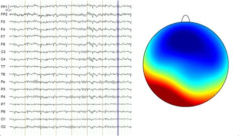 Registrazioni EEG illustrative da ratti epilettici