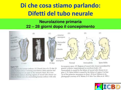 Schema dei difetti del tubo neurale