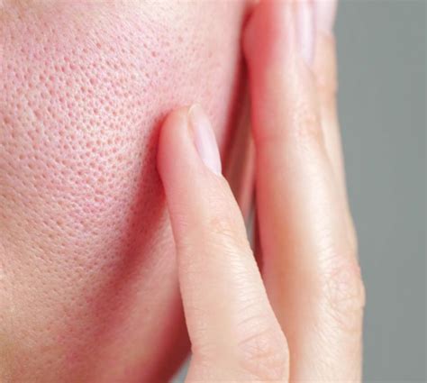 Primo piano di pelle del viso irritata e arrossata