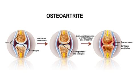 Schema che illustra l'azione della glucosamina sulla cartilagine articolare