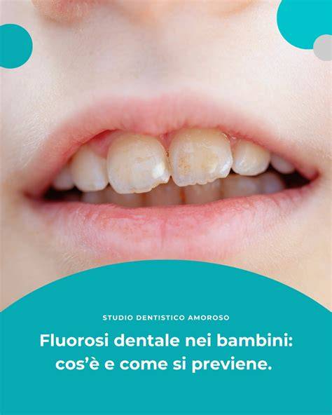 Schema sull'azione del fluoro sullo smalto dentale