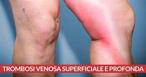 Illustrazione comparativa dei sintomi della flebite superficiale e della trombosi venosa profonda