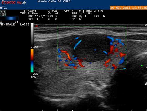 Immagine di un'ecografia tiroidea con noduli evidenziati