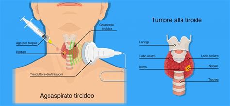 Schema che illustra la procedura di agoaspirato tiroideo