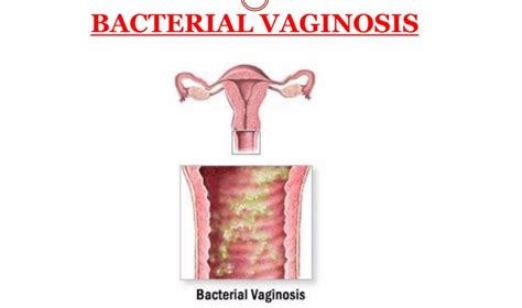 Schema diagnostico per la vaginosi batterica