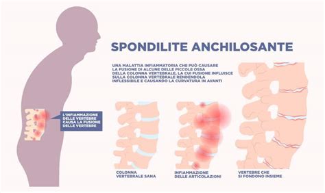Rappresentazione grafica della Spondilite Anchilosante e dei suoi effetti sul corpo