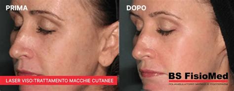 Trattamento laser per macchie cutanee