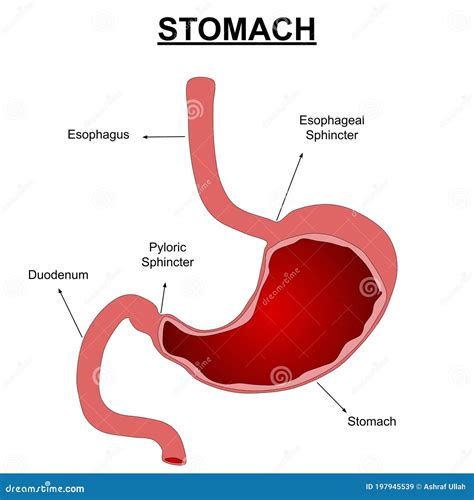 Illustrazione anatomica dello stomaco umano con evidenza della mucosa gastrica e dell'ulcera peptica