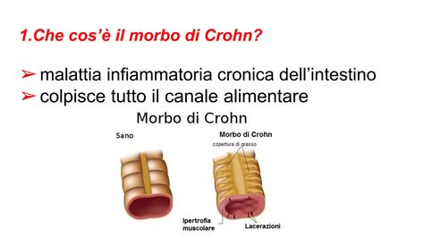 Manifestazioni extraintestinali del Morbo di Crohn