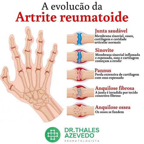 Illustrazione che mostra le differenze tra un'articolazione sana e un'articolazione affetta da artrite reumatoide
