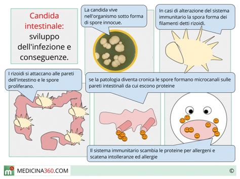 Diagramma delle cause della candida intestinale