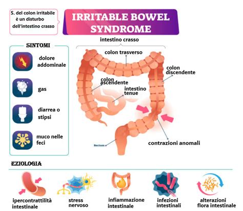 Grafico che mostra i sintomi comuni del colon irritabile