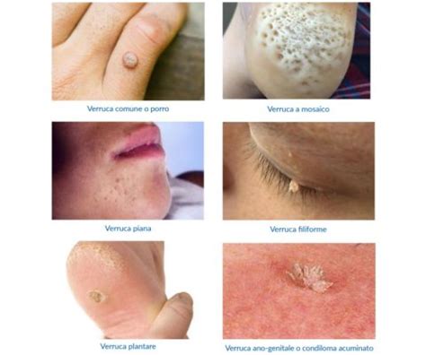Tipologie di verruche cutanee