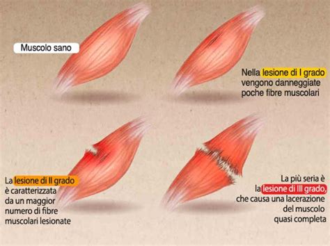 Rappresentazione della rabdomiolisi e del danno muscolare