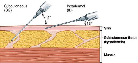 Schema di somministrazione intradermica di iniezioni di collagene