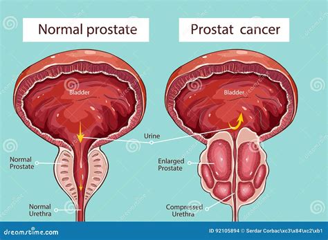 Schema anatomico della prostata maschile