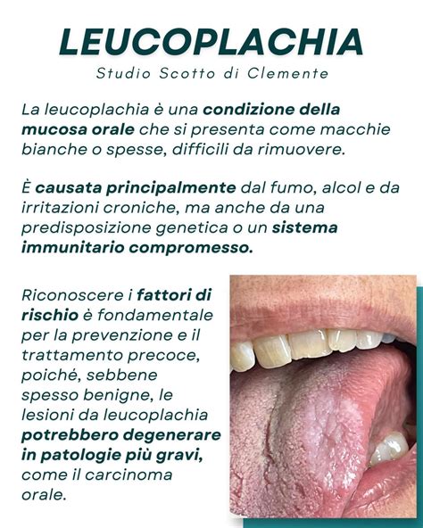 Immagine di una placca di leucoplachia sulla lingua