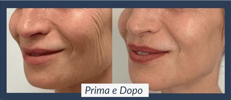 Immagine che mostra il prima e dopo della biorivitalizzazione viso