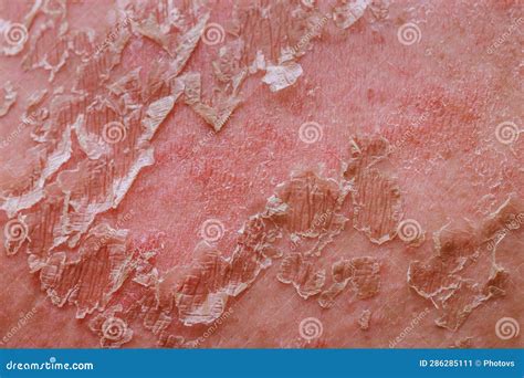 Pelle irritata con arrossamenti