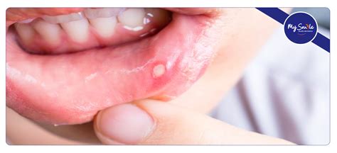 Fattori che causano le afte in bocca
