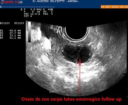 Ecografia di un corpo luteo emorragico