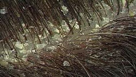 Schema delle tipologie di forfora