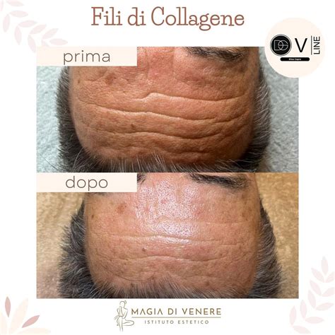 Schema di applicazione dei fili di collagene sulla pelle