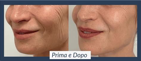 Prima e dopo: risultati della biorivitalizzazione del viso