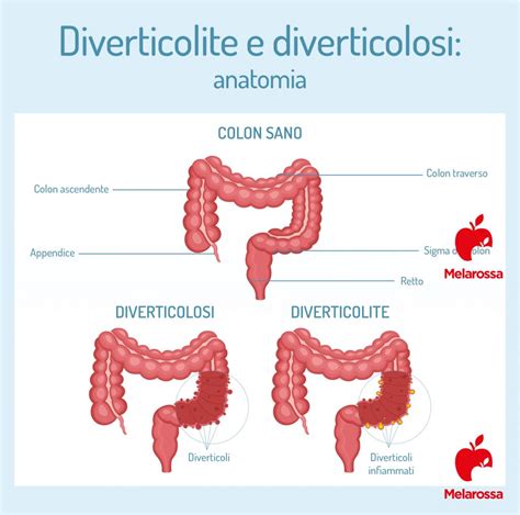 schema che illustra la differenza tra diverticolosi e diverticolite