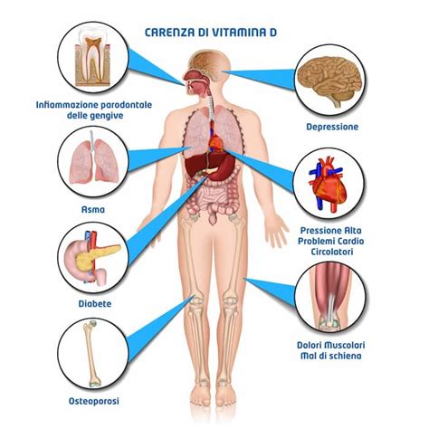 Sintomi della carenza di Vitamina D