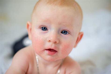 Immagine di un bambino con dermatite atopica