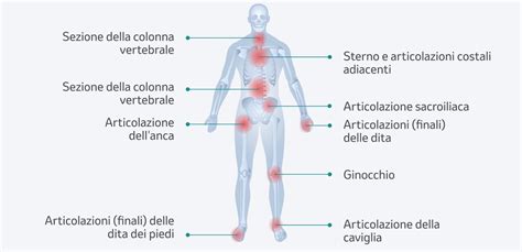 Schema delle tipologie di artrite psoriasica