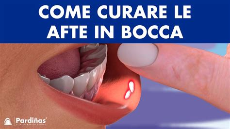 Immagine di afte in bocca