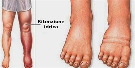 Illustrazione di gambe gonfie a causa di ritenzione idrica