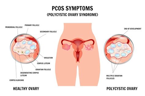 Infografica sui sintomi e le cause della PCOS