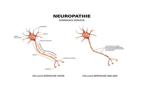 Schema delle cause delle neuropatie
