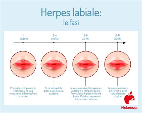 Comparazione tra retinolo e herpes labiale