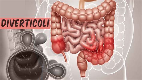 Schema della formazione dei diverticoli nell'intestino