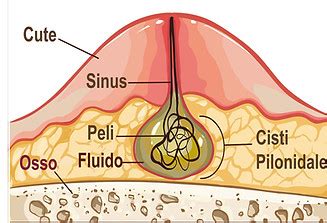Schema anatomico della regione sacro-coccigea con evidenziazione della cisti pilonidale e dei tramiti fistolosi