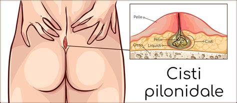 Infografica sulle cause e i sintomi della cisti pilonidale