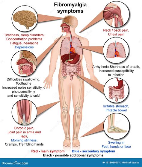 Illustrazione schematica della fibromialgia con i sintomi principali