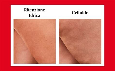 Infografica che illustra la differenza tra ritenzione idrica intracellulare ed extracellulare