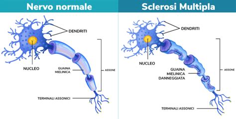 Illustrazione della mielina che ricopre un assone neuronale e la sua degenerazione nella Sclerosi Multipla