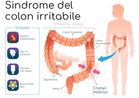 Infografica sui sintomi e cause del colon irritabile