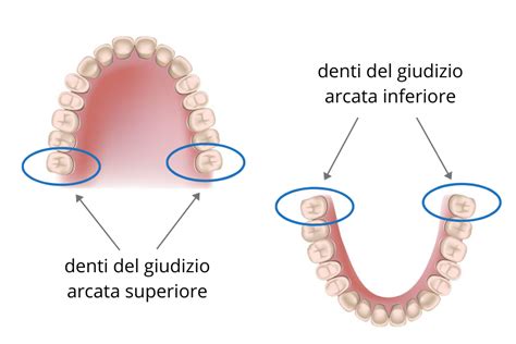 Schema anatomico del dente del giudizio e della gengiva circostante