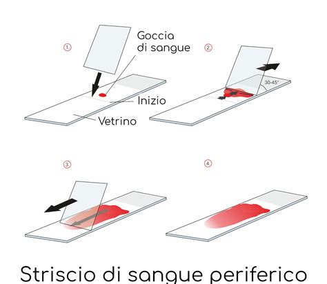 Striscio di sangue periferico con presenza di virociti